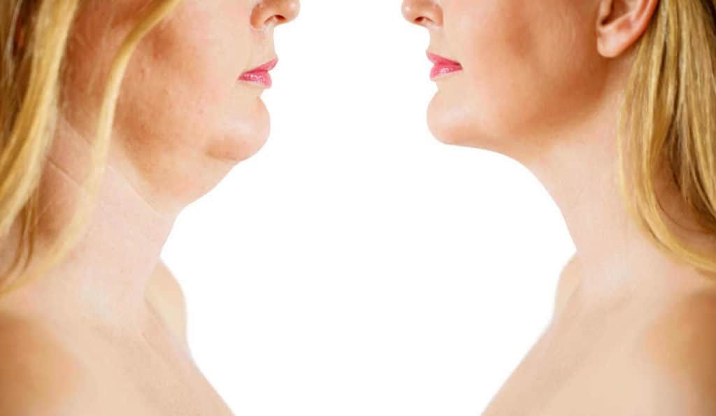 Double Chin treatment Greater London (Westminster) before and after results