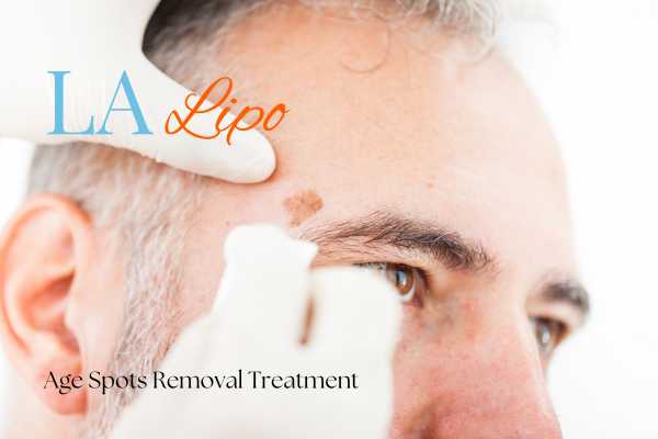 What Are the Most Effective Treatments for Age Spots Greater London (Westminster)?