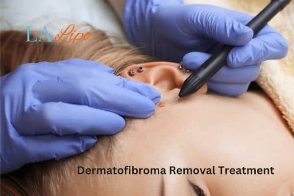 Dermatofibroma Removal Treatment Greater London (Westminster)
