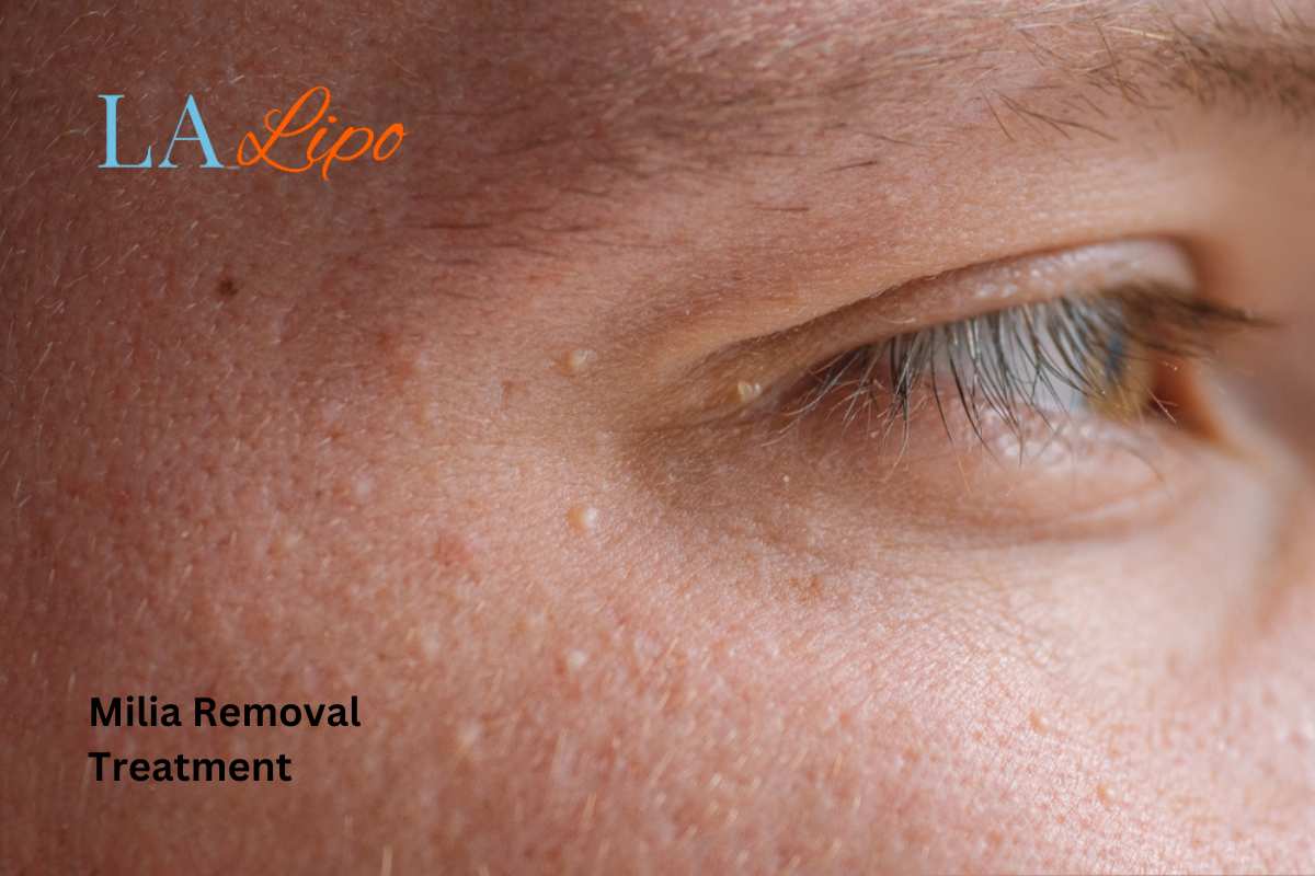 Cryopen Milia Removal: Is It the Easiest and Safest Option Greater London (Westminster)?