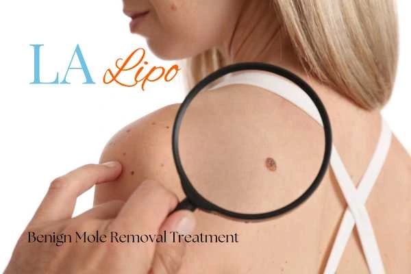 Why getting moles removed Greater London (Westminster) can boost your confidence!