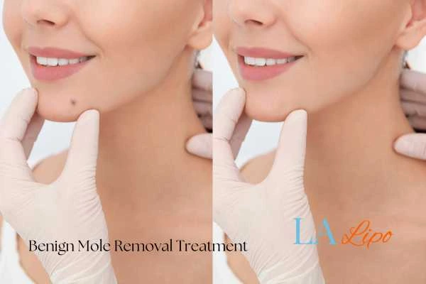 Woman's before and after results of being moles removal treatment Greater London (Westminster)
