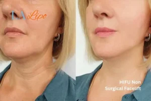 hi-fu for wrinkles Greater London (Westminster) before and after results