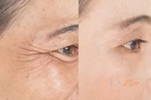 Before and after results of woman - HI-fu wrinkles reduction treatment Greater London (Westminster)