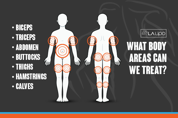 Graphic to show areas you can have LA-EMS Body Sculpting Greater London (Westminster) treatment.