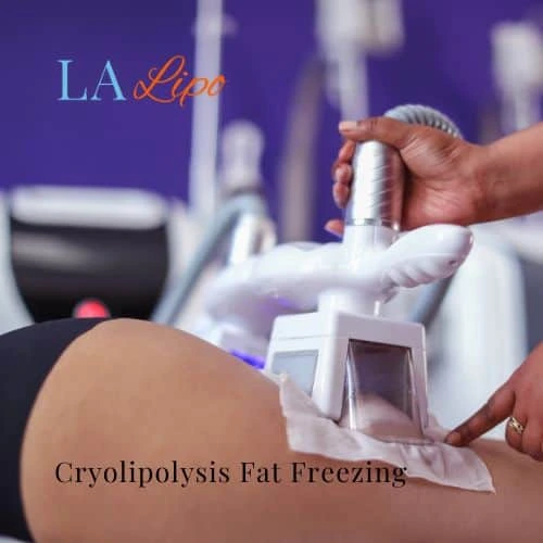 fat freezing - Cryolipolysis Greater London (Westminster)