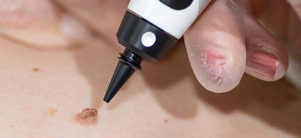 skin tag removal using cryopen Greater London (Westminster)