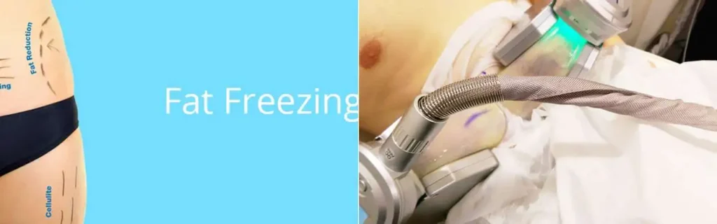 multi areas of a persons body having coolsculpting Greater London (Westminster) treatment