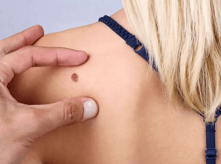 woman having mole removal Greater London (Westminster) consultation before treatment.
