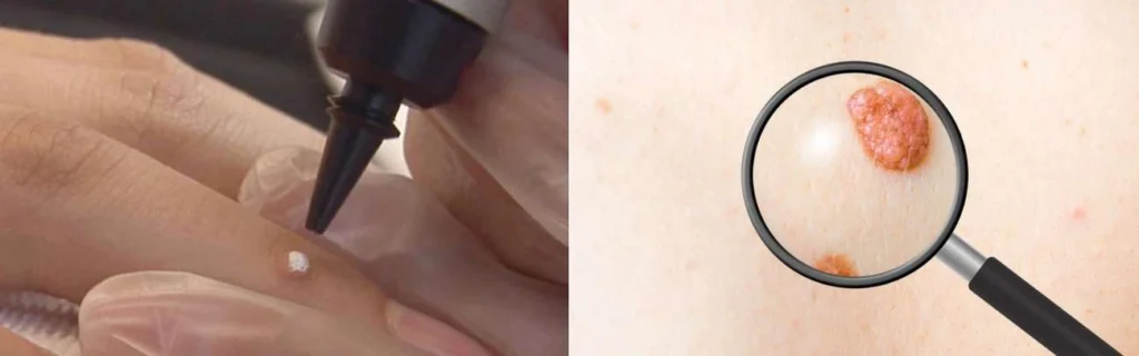 Person getting moles removed with cryopen Greater London (Westminster)