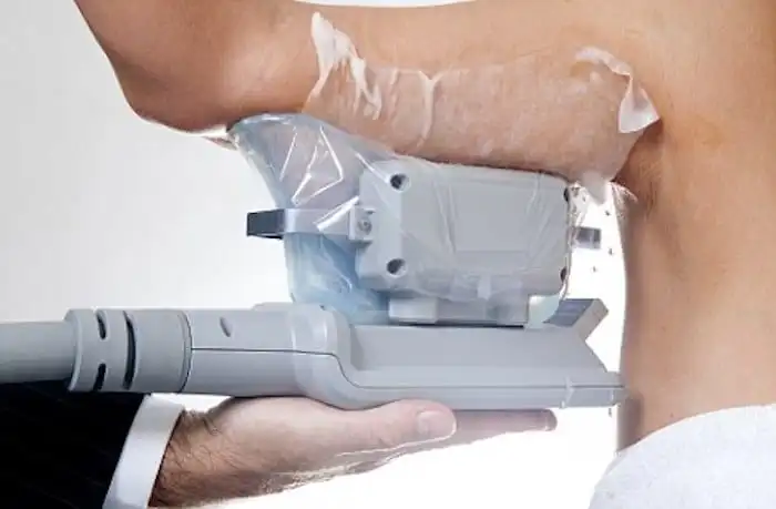 Picture of fat freezing Greater London (Westminster) on the upper arms.