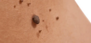 image of a skin tag Greater London (Westminster)