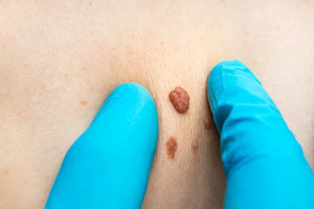 Consultant examining a skin tag Greater London (Westminster)