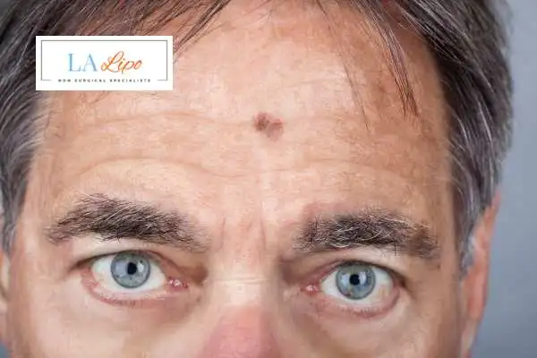 Solar Lentigo Removal Greater London (Westminster) image of man with mark on his forehead
