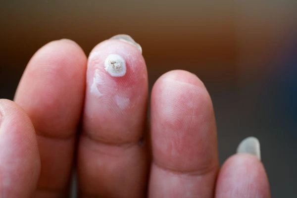 wart on person finger - cryotherapy to treat from LA LIPO Greater London (Westminster)