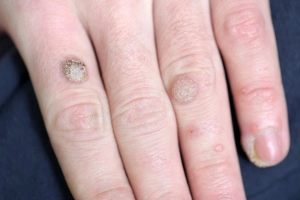 photo of warts on person hand - see wart removal Greater London (Westminster) from LA LIPO
