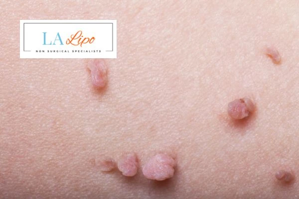 Does cryopen skin tag removal Greater London (Westminster) hurt? Find out now call our team today!