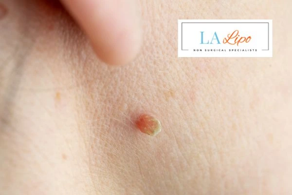 Book skin tag removal Greater London (Westminster) today speak to our team now!