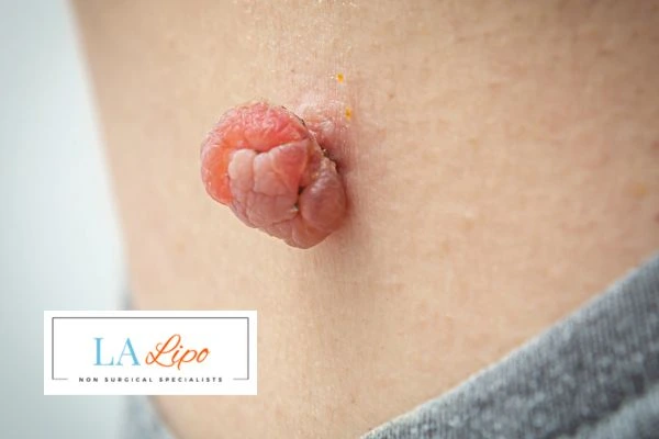 Interested in skin tag removal Greater London (Westminster)? Concerned about the pain? Find out more today!