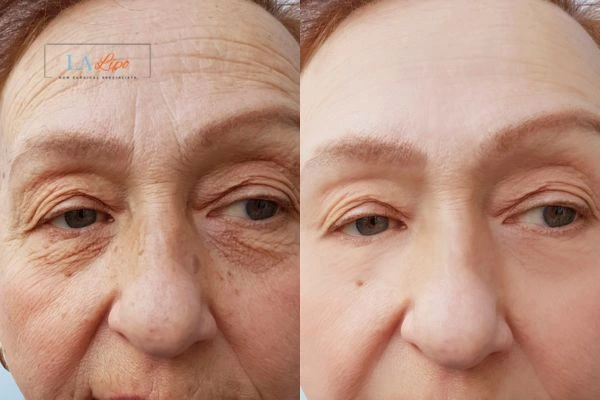 The powerful benefits of Morpheus8 Treatment Greater London (Westminster) - Call Our team today!