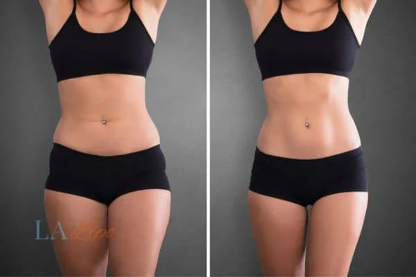 before and after results of non-surgical treatment to help a woman's body image and mental health Greater London (Westminster)