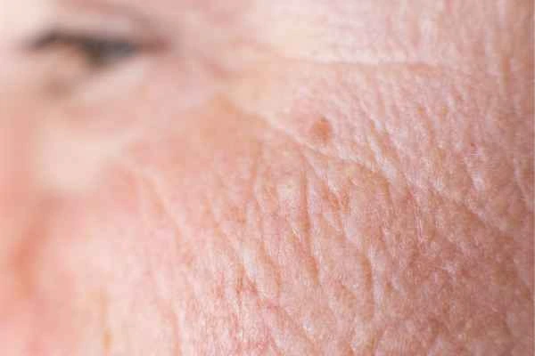 close up picture of a woman's face showing an age spot Greater London (Westminster)