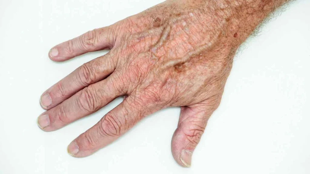 Male hand showing age spot Greater London (Westminster)