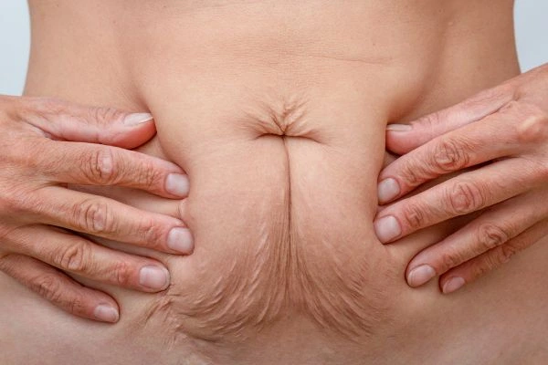Image of a woman's stomach with loose skin - example of skin tightening Greater London (Westminster) options
